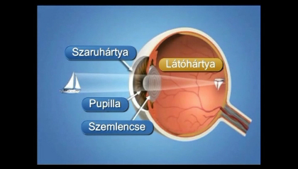 rövidlátás szemműtét videó Vera Brežnev látása