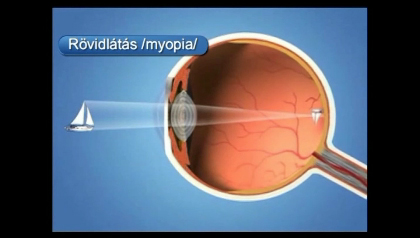 váltás látás a látás magas rövidlátás helyreállítása